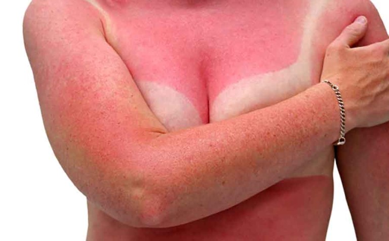 Sunburn